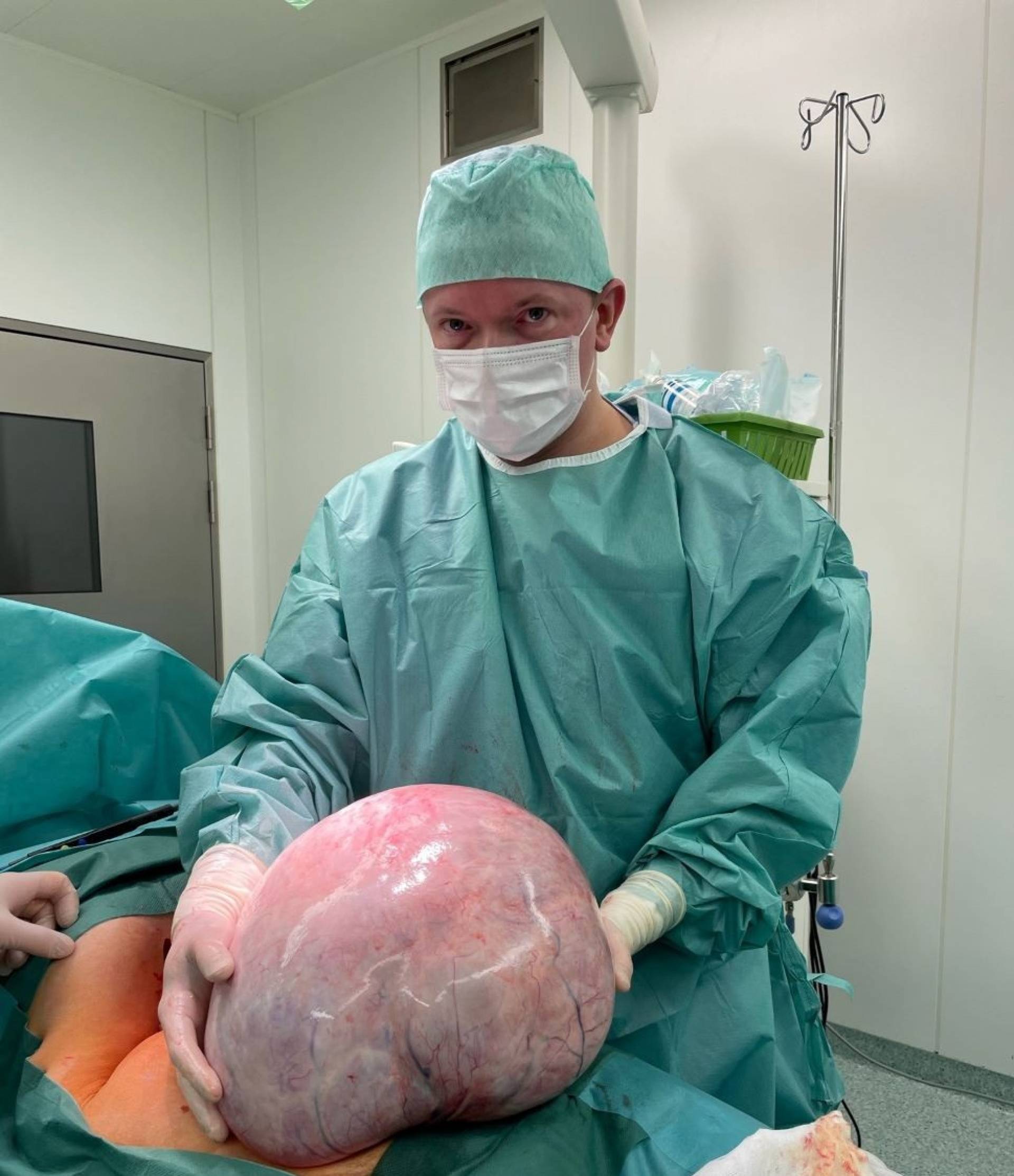Krakowscy lekarze usunęli guz o wadze 15 kg. Pacjentka myślała, że... przytyła