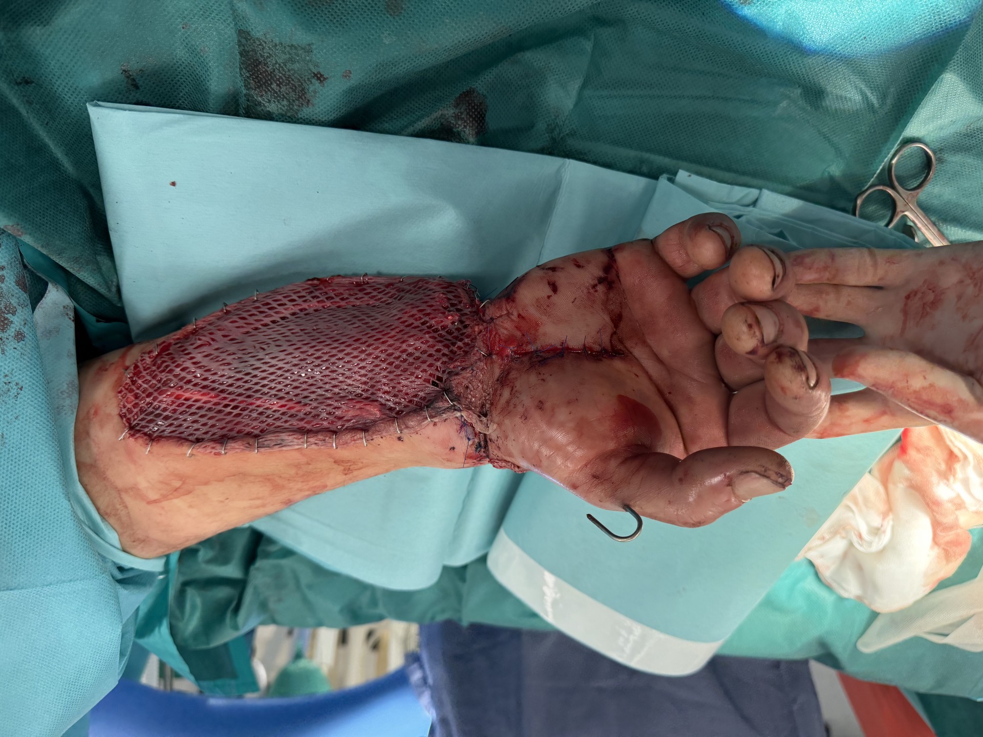 Niesamowita operacja w krakowskim szpitalu. Uratowali i przyszyli uciętą dłoń